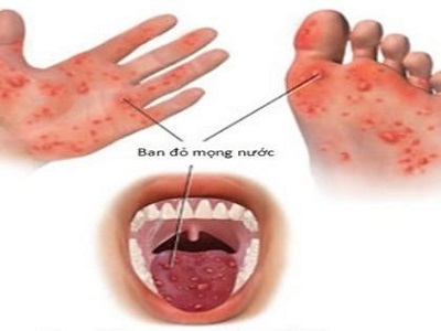 Chân tay miệng là bệnh do virus gây ra và rất dễ lây lan thành dịch.