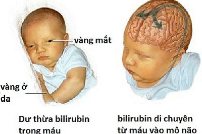 Bại não là biến chứng nguy hiểm có thể gặp phải ở trẻ bị vàng da bệnh lí sau sinh.