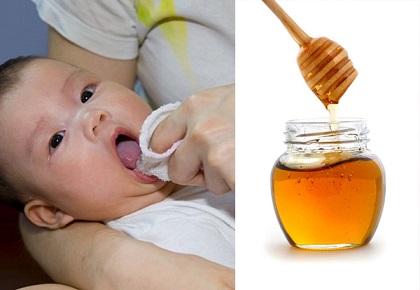 Dùng mật ong trị tưa lưỡi ở trẻ sơ sinh gây tác hại khôn lường